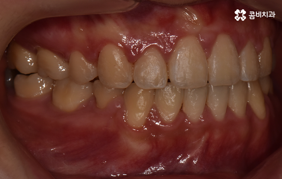 돌출입발치교정 기대해봐도 될까요 관련 이미지 13