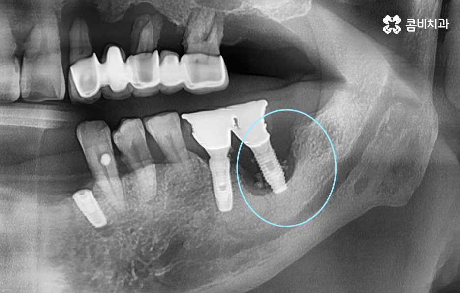 노인임플란트 이것만큼은 기억하세요 관련 이미지 2