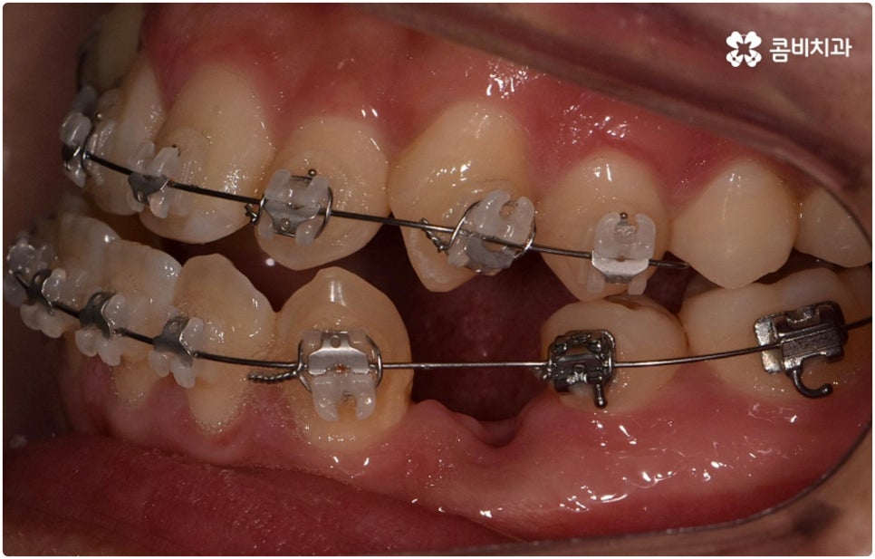 부정교합 3급 고치는 방법은 관련 이미지 8