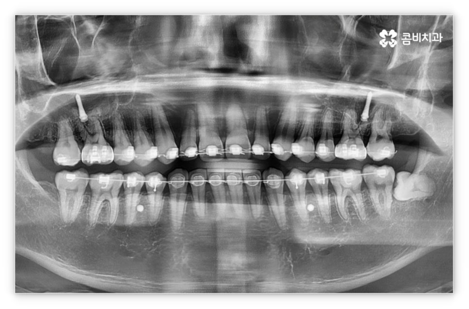 앞니설측교정 망설여질때는 관련 이미지 8