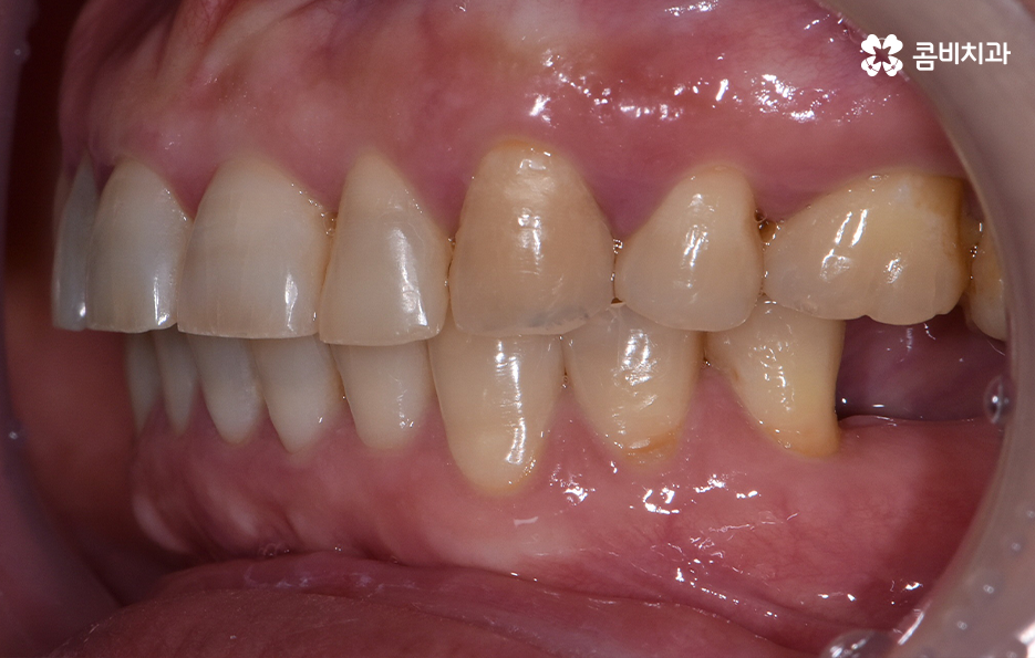 임플란트 해야 하는데 치아교정이 하고 싶다면 관련 이미지 4