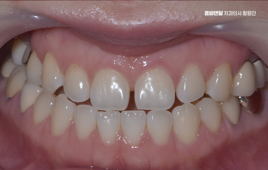 반대교합 치아교정 해결 가능할까 관련 이미지 1