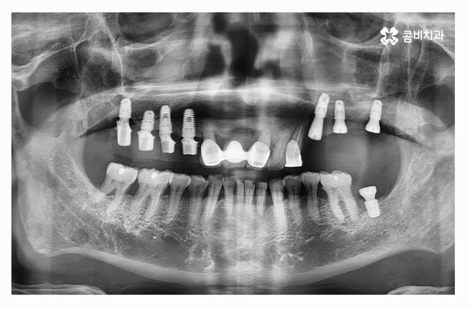 전체임플란트 신중하게 결정하려면 관련 이미지 5