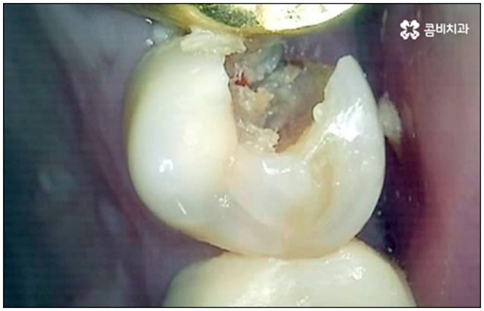 당일임플란트 나도 할수있나요 관련 이미지 7