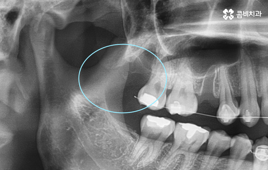 매복사랑니 냄새 방치하면 이런 문제도 생겨요 관련 이미지 6