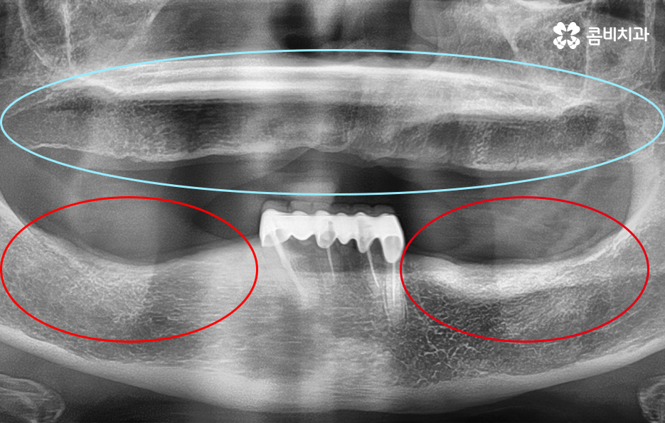 65세이상임플란트 고령이기에 간과하지 말아야 할 사항은 관련 이미지 2