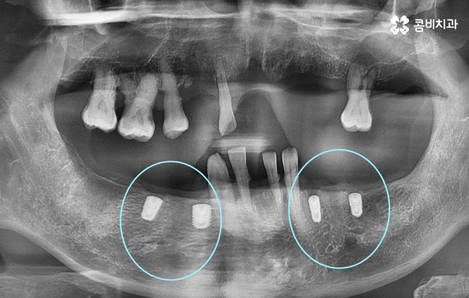 전체임플란트 어떤 방식으로 해야하나요 관련 이미지 2