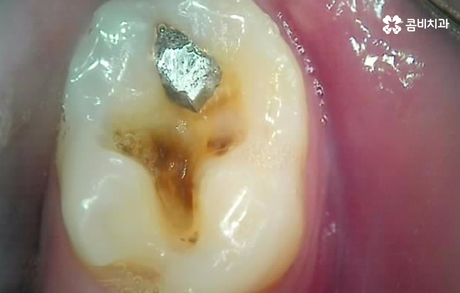 어금니 충치 깨짐 판단기준부터 세워보세요 관련 이미지 7