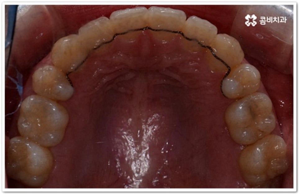 덧니 발치 언제 하나요? 관련 이미지 12