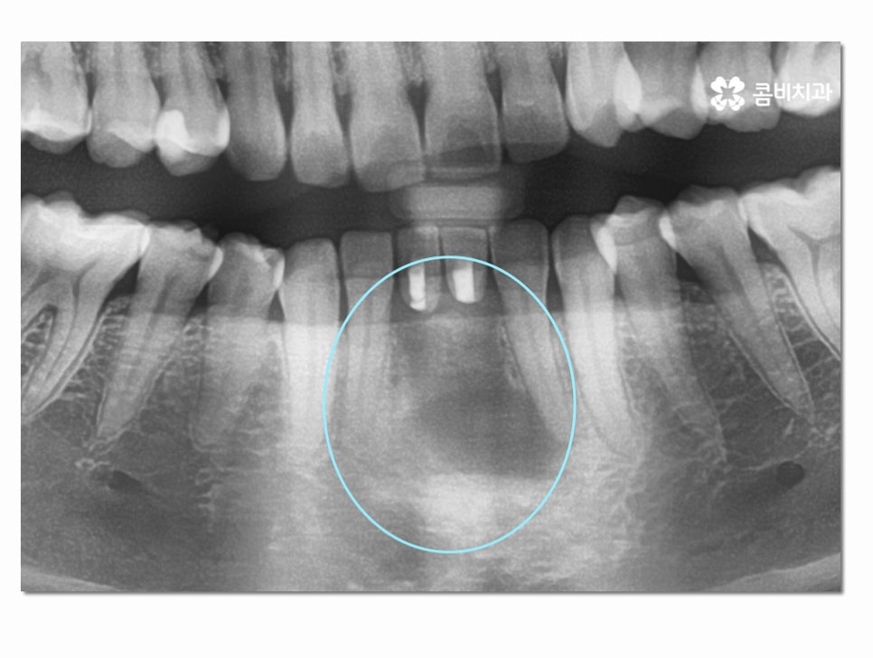 치주염으로 인한 아랫니 임플란트 절차를 알아보면 관련 이미지 5