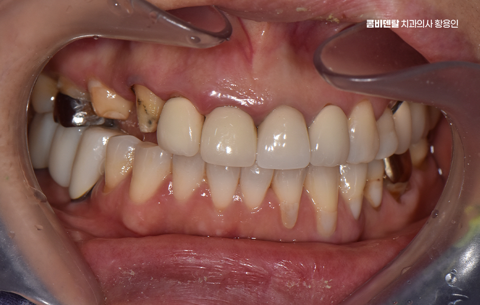앞니 크라운 교체 깔끔하게 정리하려면 관련 이미지 3
