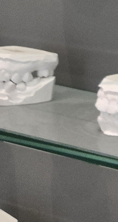 윗니 전체 임플란트 뭐부터 해야할까 관련 이미지 31