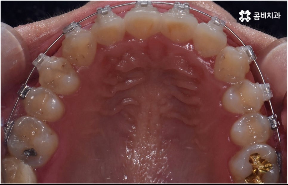 성인 치아교정 기간 걱정이 앞서나요 관련 이미지 10