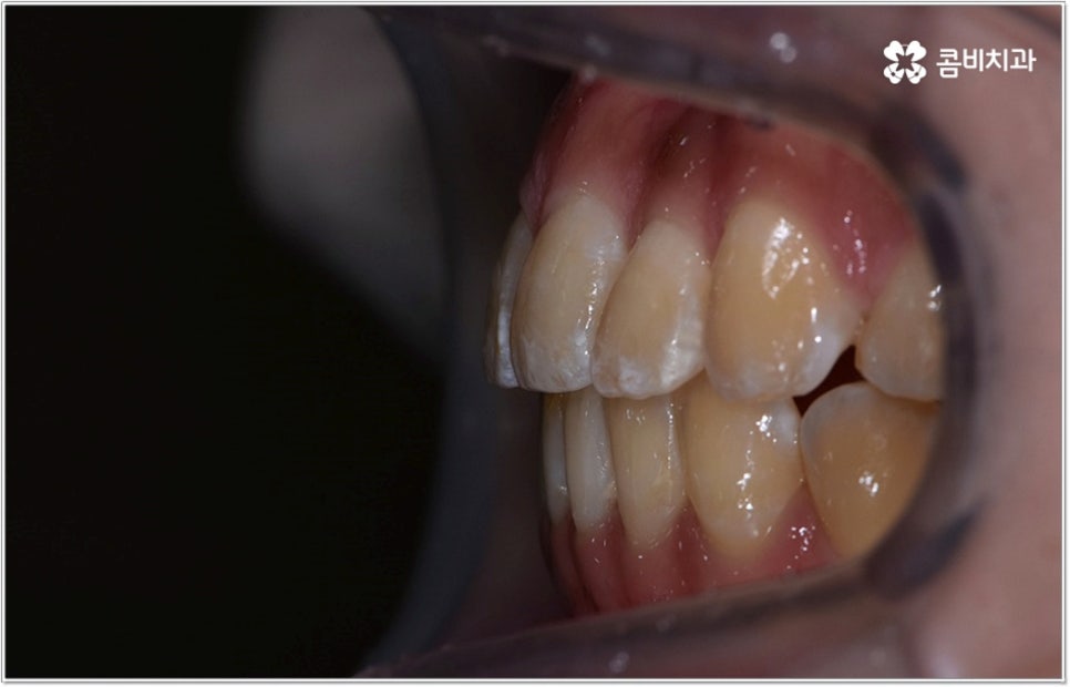 비발치치아교정 언제 할수있나요 관련 이미지 11