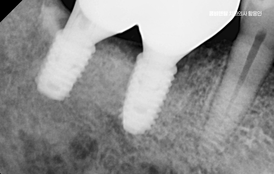 어금니 임플란트 과정 제대로 이해하려면 관련 이미지 11