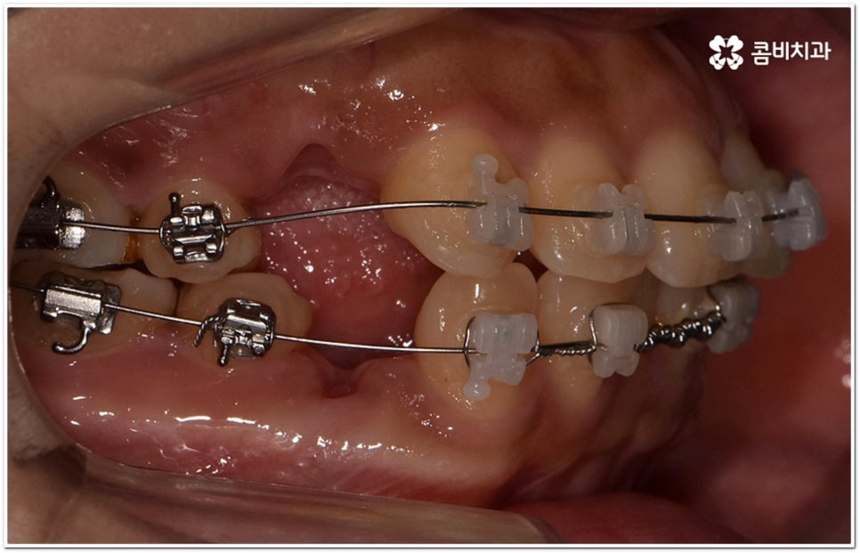 돌출입교정치과 알아보는 기준은 관련 이미지 8