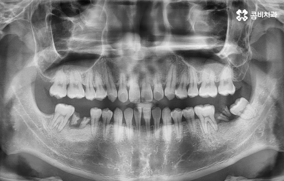 클리피씨교정 늦지않게 결정하려면 관련 이미지 6