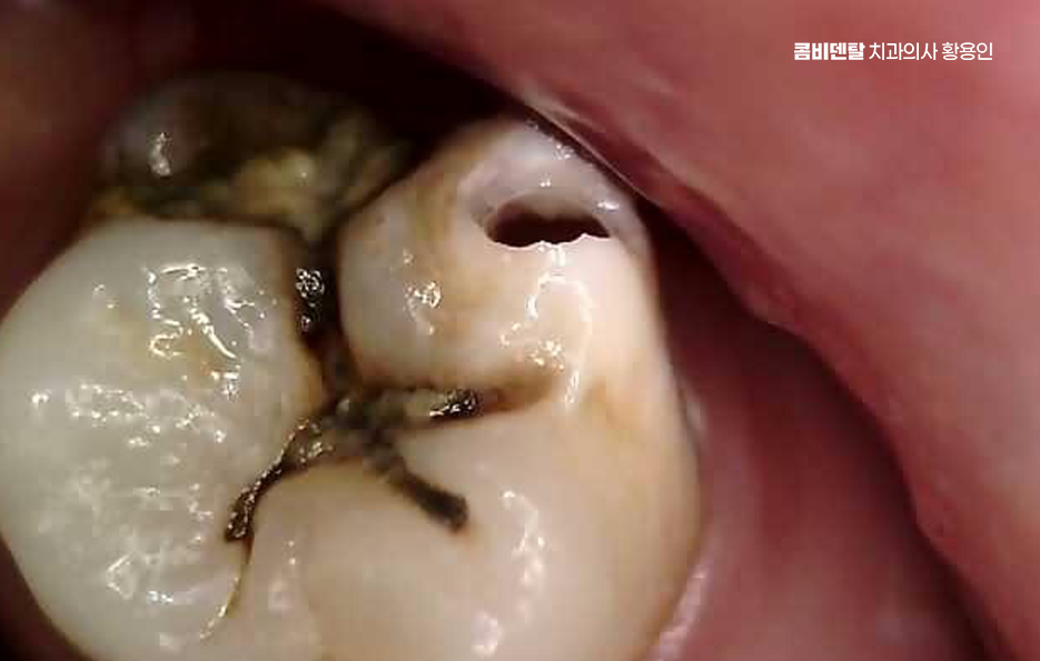 신경치료 아픈가요 망설이시는 분들이라면 관련 이미지 9