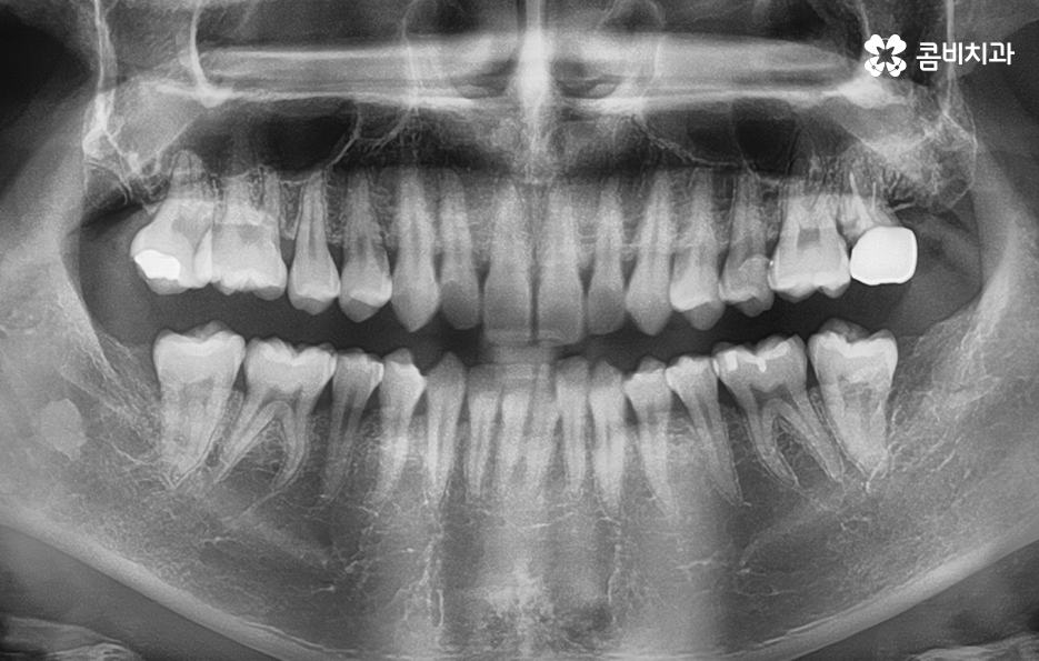 어금니 발치후 임플란트 이런점을 주의합시다 관련 이미지 1