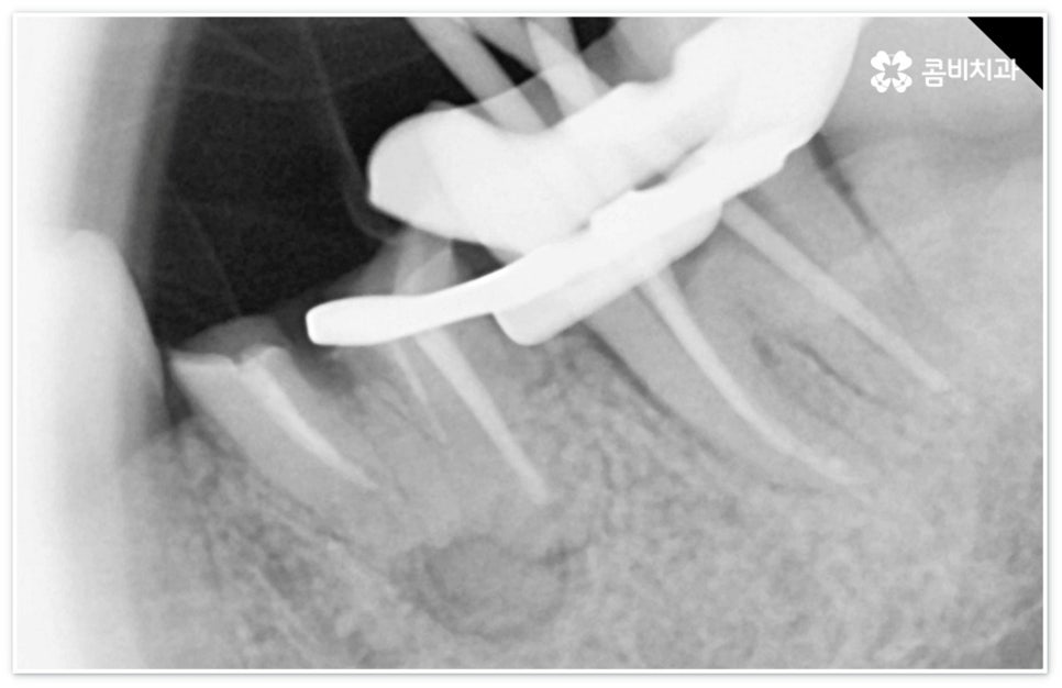 신경치료통증 무섭다고 미루면 관련 이미지 7