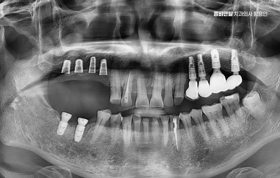 어금니 임플란트 과정 제대로 이해하려면 관련 이미지 7