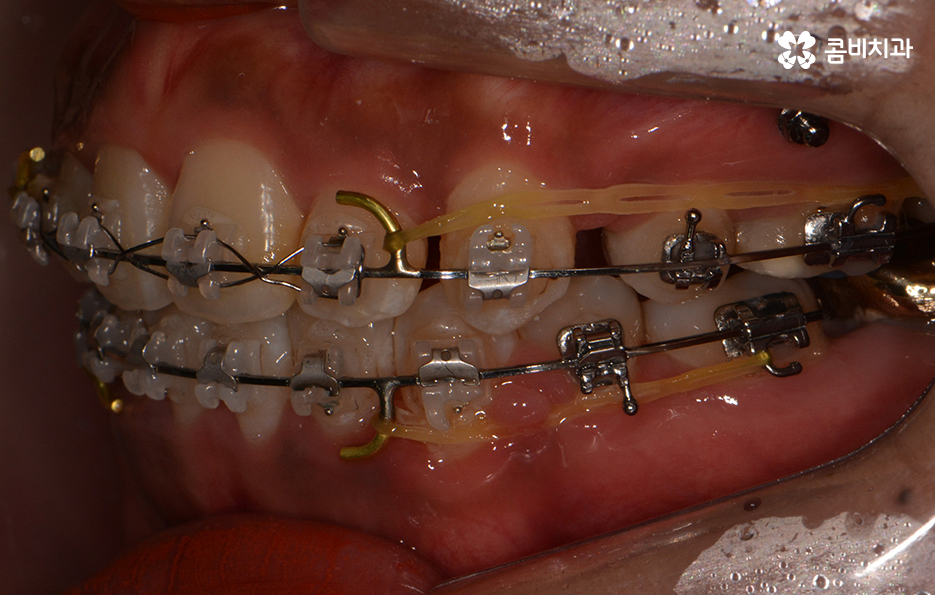 클리피씨교정 알아볼 때 꼭 신경 써야 하는 점은! 관련 이미지 8