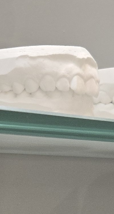 앞니 틀어짐 부분교정 얼마나 걸릴까 관련 이미지 26