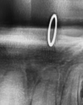 어금니 뒤 잇몸 부음 어떤 문제길래 이런거죠 관련 이미지 23