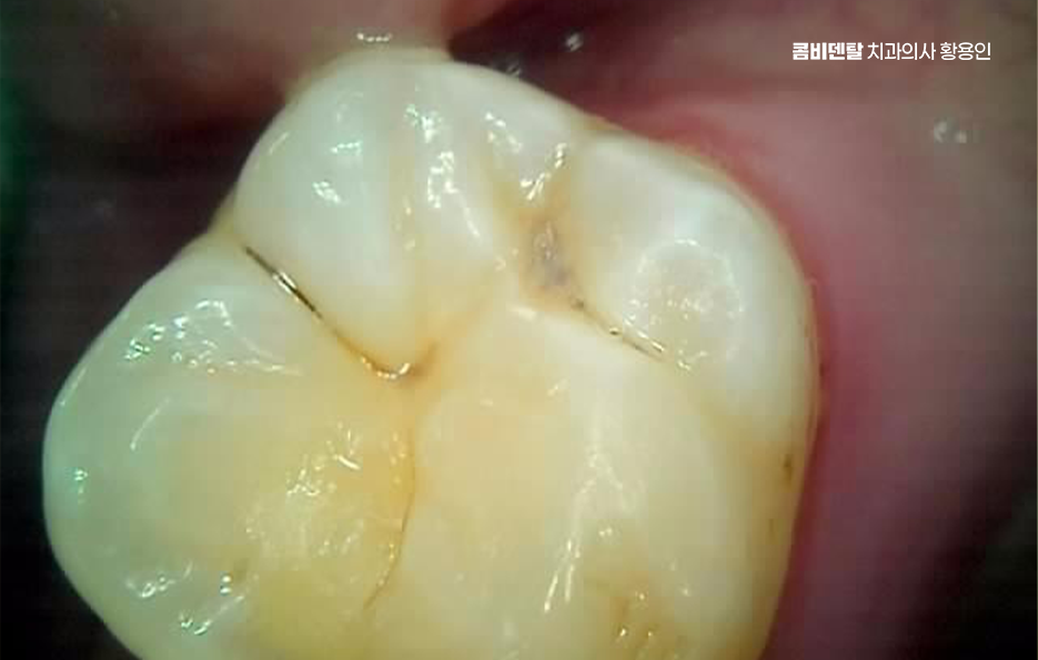 충치 검은점 나타났다면 이렇게 대처해요 관련 이미지 6