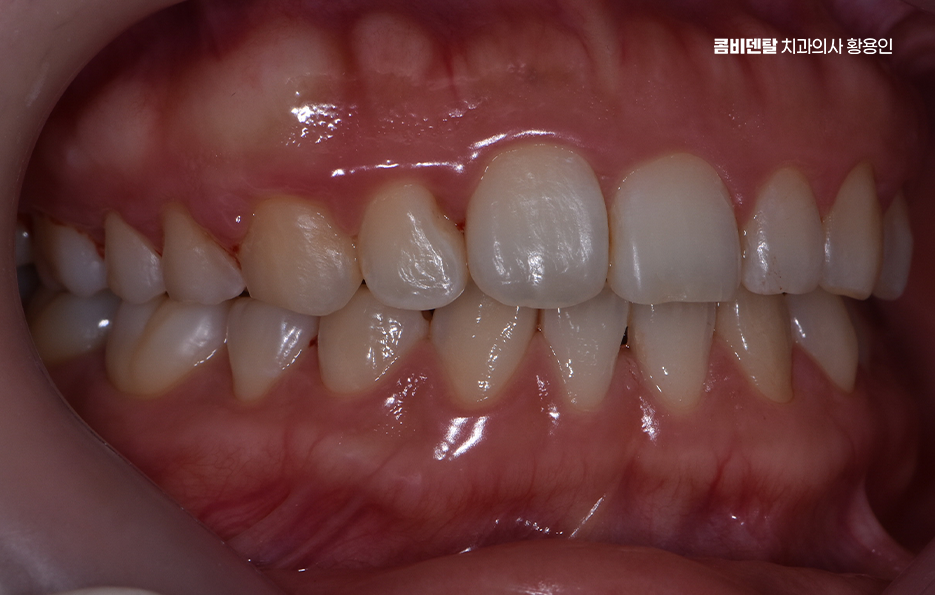 치아교정 통증 줄이는 방법 어떻게 가능할까요 관련 이미지 10