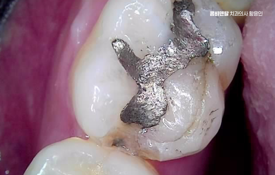 치아 시림 통증 갈수록 심해지다면 관련 이미지 4