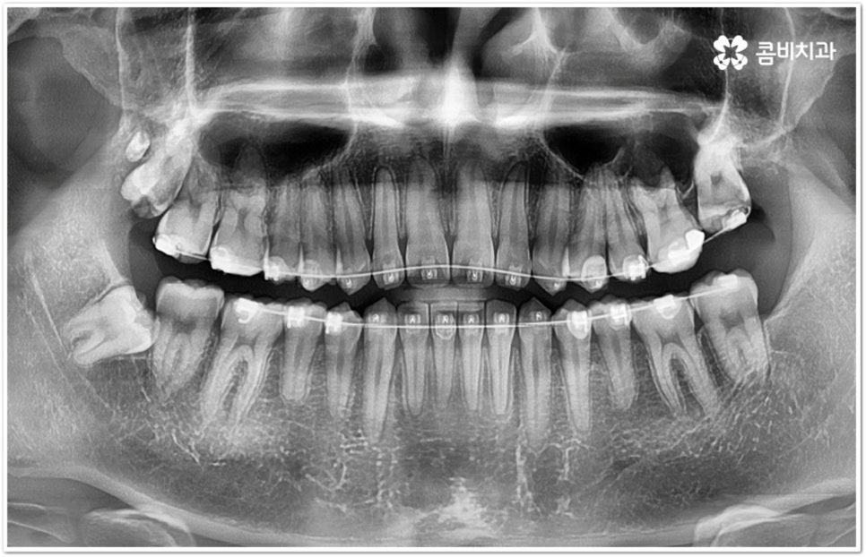 아래사랑니발치 망설이고 있다면 관련 이미지 7