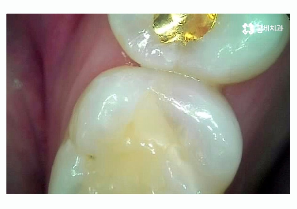 충치 떼우기 스무살이후에 조심해야 할 점은? 관련 이미지 5