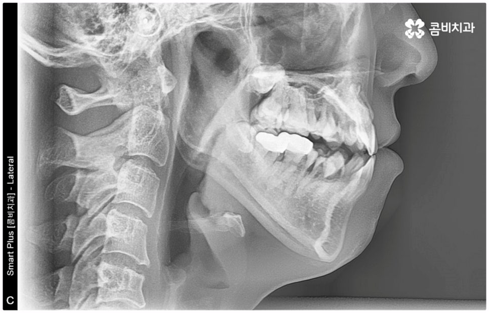 반대교합교정 늦지 않았어요 관련 이미지 2