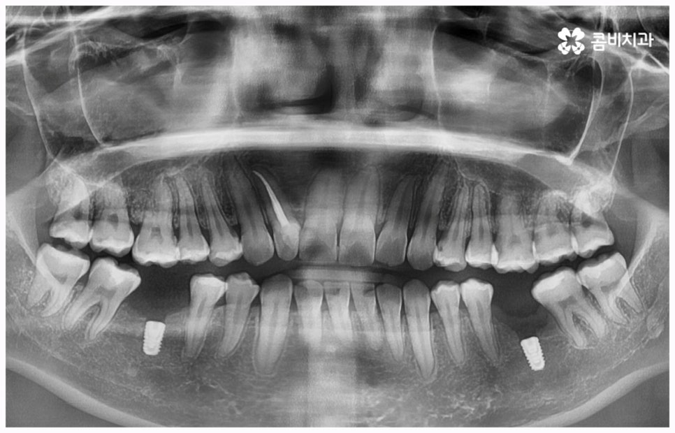 임플란트 종류 어떤게 맞을까요? 관련 이미지 3