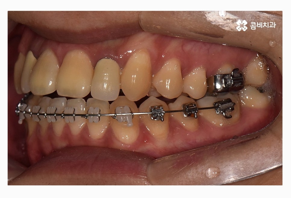 콤비교정 올바르게 판단하려면 관련 이미지 13