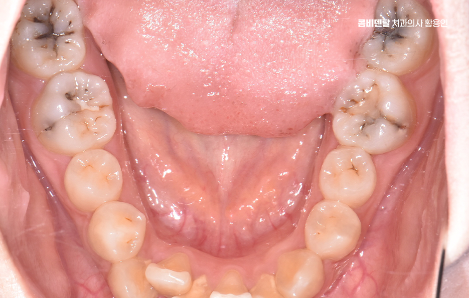 신경치료 아픈가요 망설이시는 분들이라면 관련 이미지 1