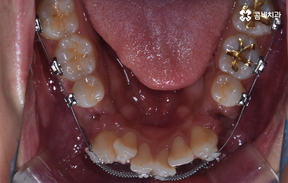 덧니 발치 교정 현명하게 선택하려면 관련 이미지 12