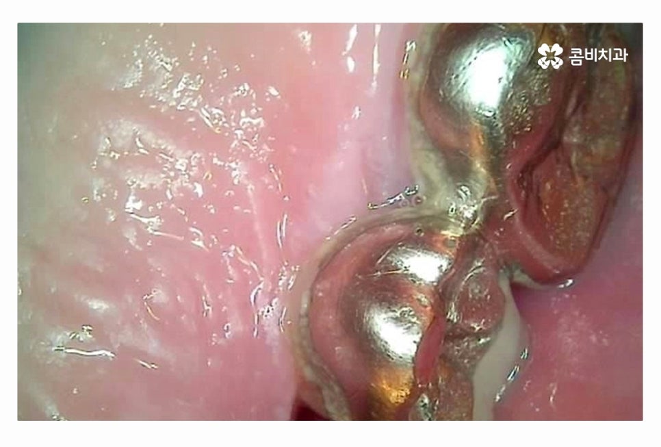 20대임플란트 갈수록 늘어나는 이유는 관련 이미지 7