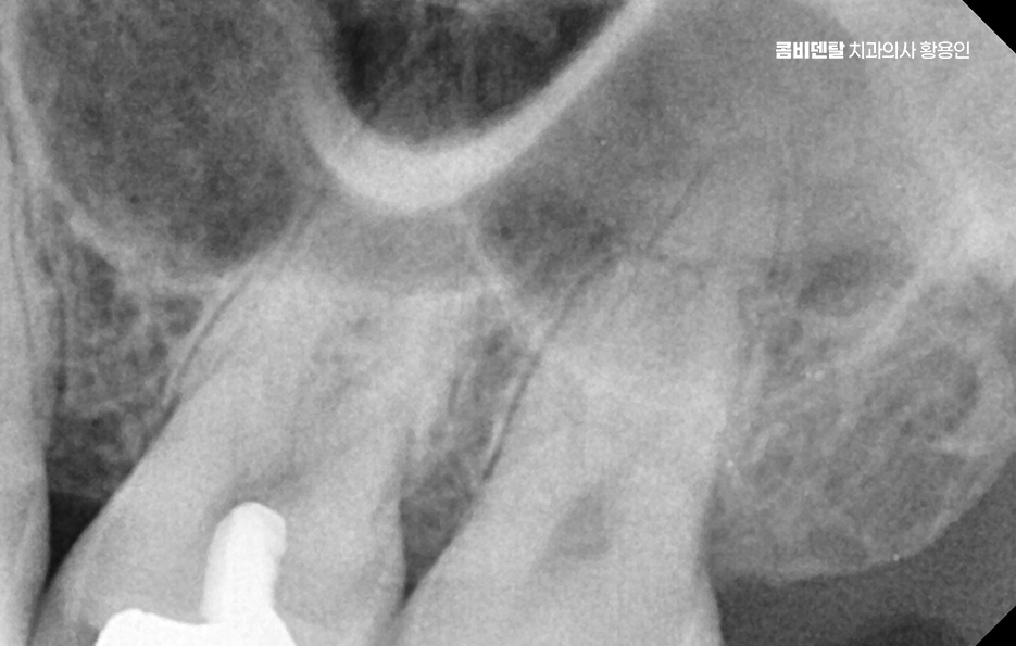 인레이 치료 후 통증 자꾸 심해지는데 괜찮은걸까 관련 이미지 6
