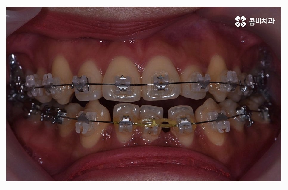 덧니교정 정교하게 따져보려면 관련 이미지 7