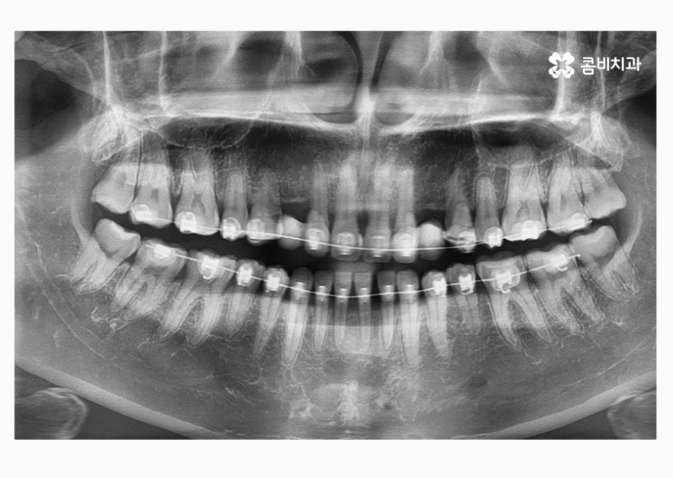 30대임플란트 향후 미래를 바라본다면 관련 이미지 7