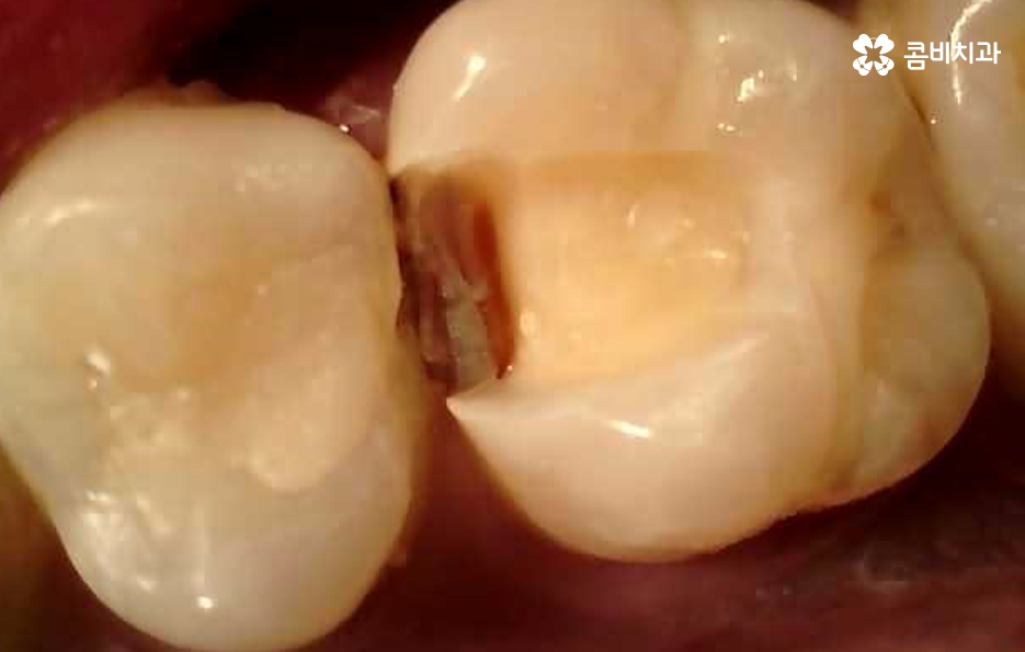 레진 인레이 치료 후 2차충치 왜 발생하고 어떻게 대처할까 관련 이미지 8