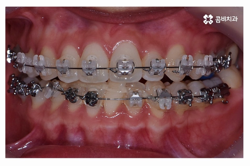 덧니교정 체계적으로 준비하려면 관련 이미지 9