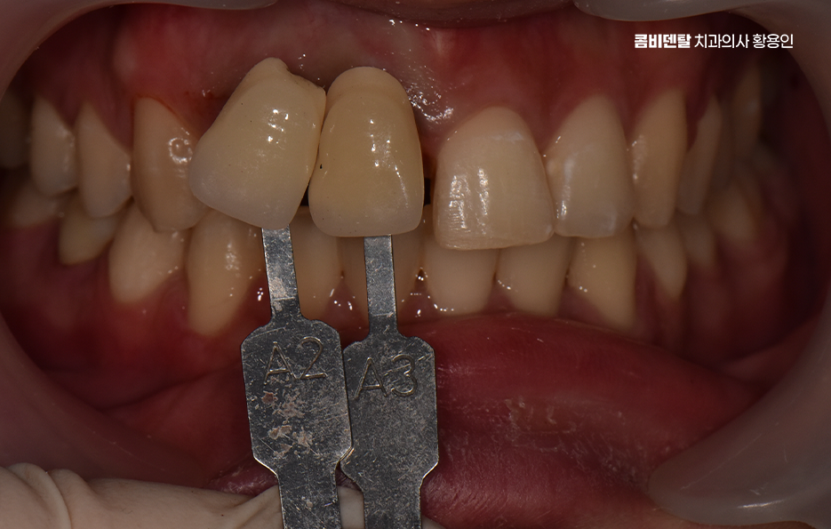깨진 앞니 크라운 어떻게 해야 깔끔하게 해결될까 관련 이미지 5