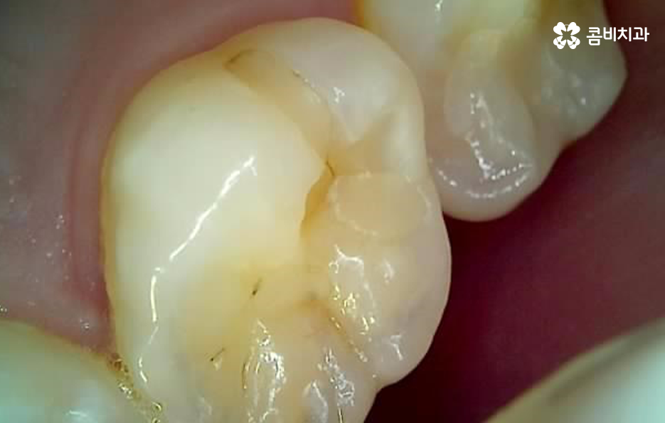 어금니 레진 깨짐 변색 안아파도 이렇게 대처하세요 관련 이미지 13