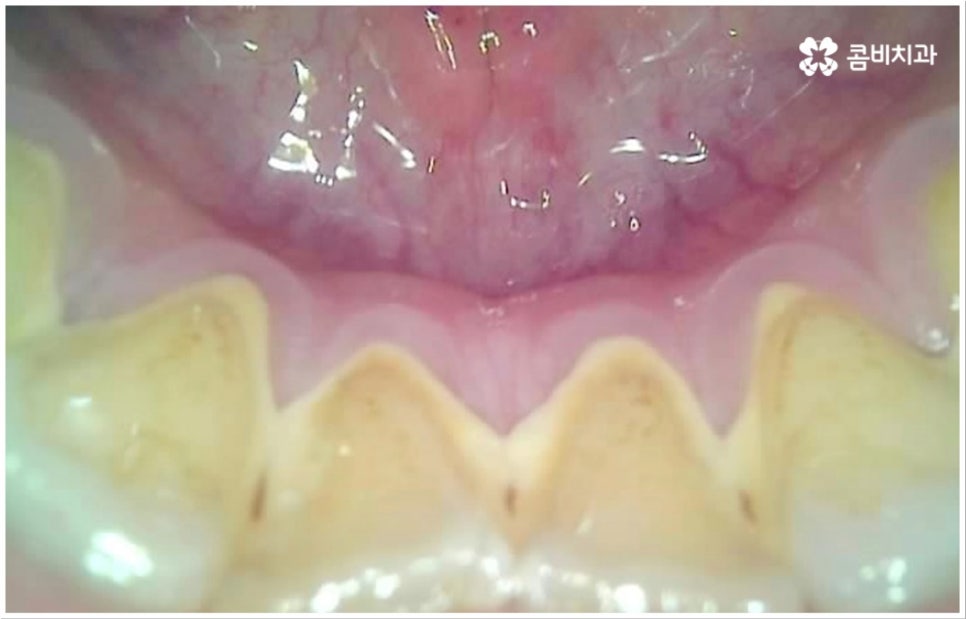 충치 통증 참지마세요 관련 이미지 9