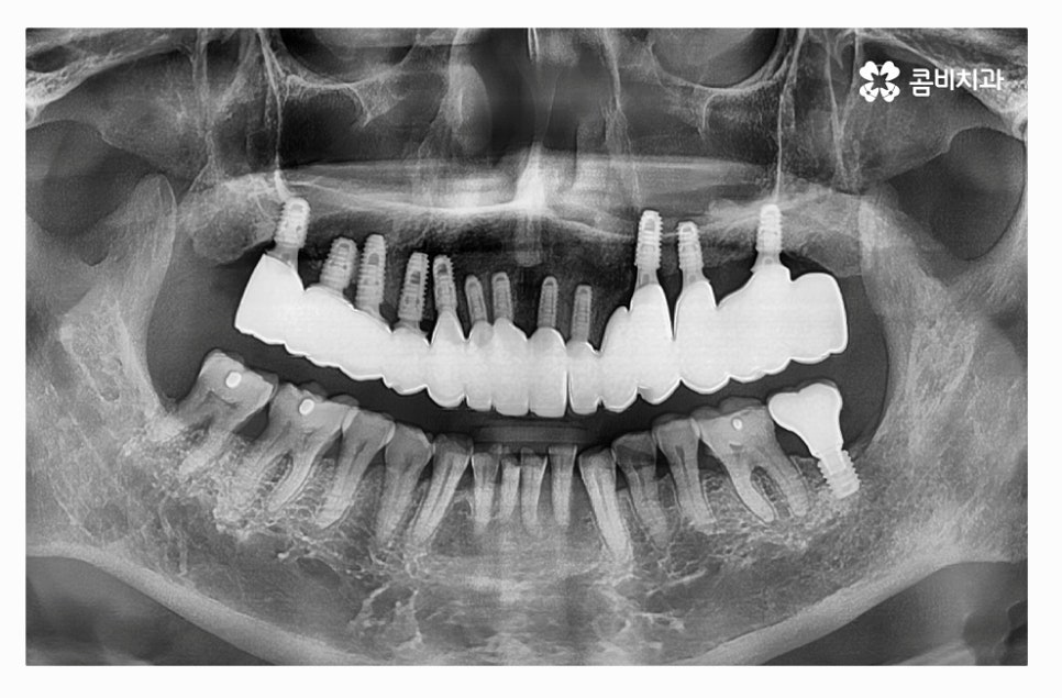 전체임플란트 신중하게 결정하려면 관련 이미지 10