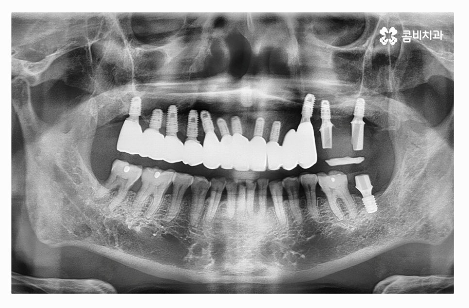 전체임플란트 신중하게 결정하려면 관련 이미지 9