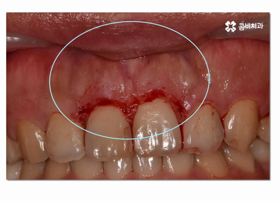 치주질환 치료의 중요성과 치은절제술이 활용된 사례 관련 이미지 4